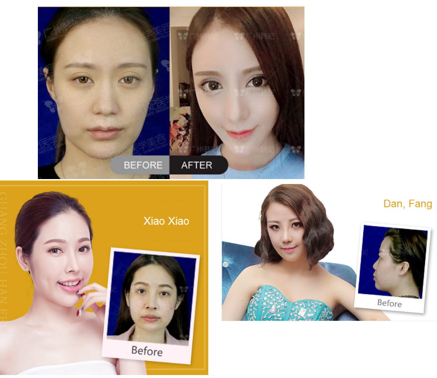 real rhinoplasty effect