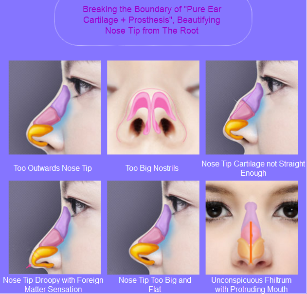 nasal tip locking