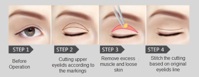 ptosis correction