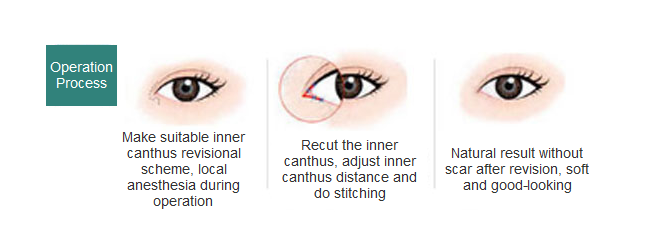 eye plasty revision