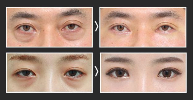 eye anti-aging