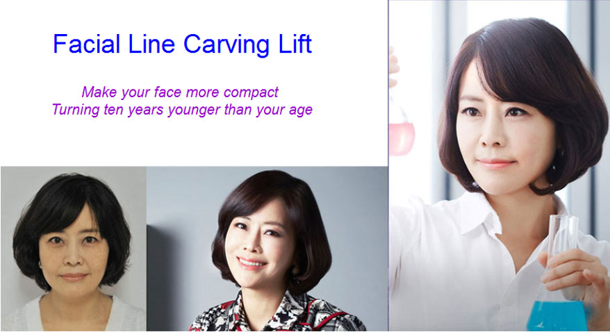facial line carving lift