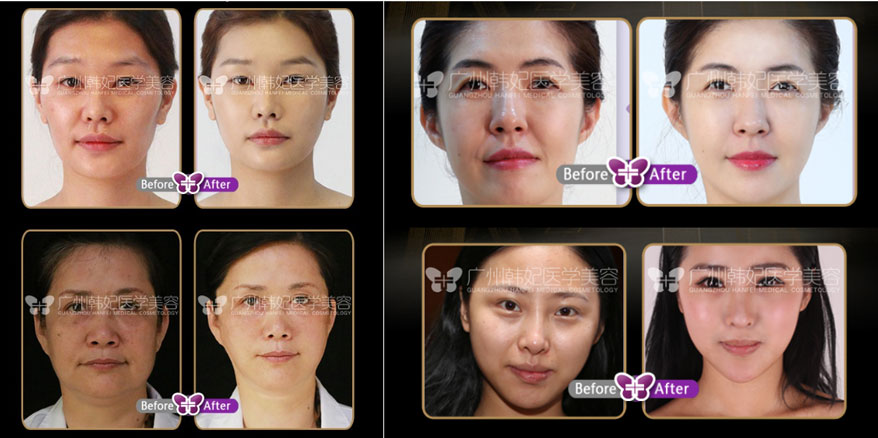 facial line carving lift