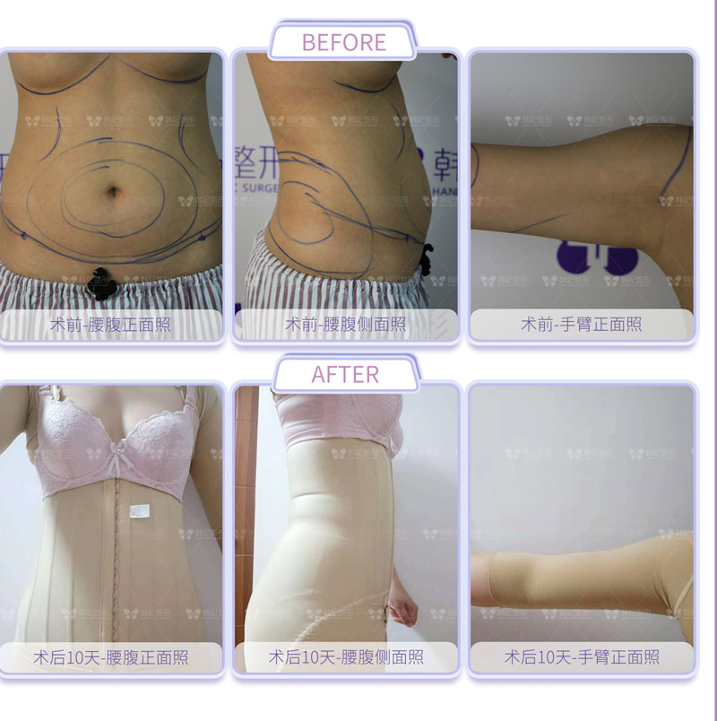 hanfei liposuction in china, face,neck,waist,abdomen,back,arms, legs cost 5000-20000rmb