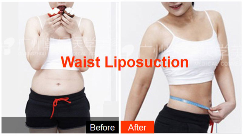 hanfei liposuction in china, face,neck,waist,abdomen,back,arms, legs cost 5000-20000rmb