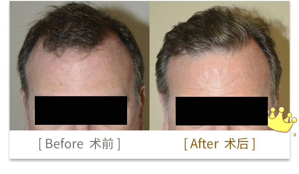 hair transplant china