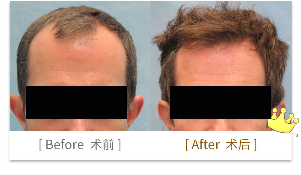 hair transplant china