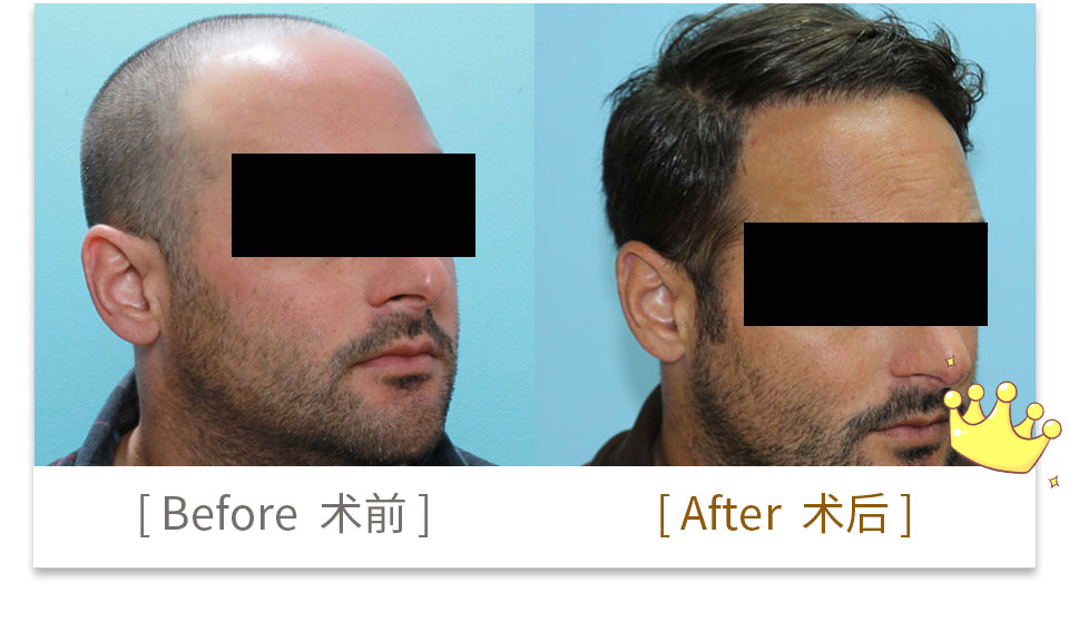 hair transplant china